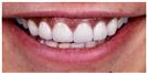 Dental Veneers - Dr. Michael’s Dental Clinics