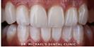 Dental Veneers - Dr. Michael’s Dental Clinics