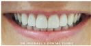 Dental Veneers - Dr. Michael’s Dental Clinics