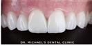 Dental Veneers - Dr. Michael’s Dental Clinics