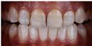 Dental Veneers - Dr. Michael’s Dental Clinics