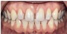 Dental Veneers - Dr. Michael’s Dental Clinics
