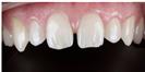 Dental Veneers - Dr. Michael’s Dental Clinics