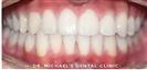 Dental Braces - Dr. Michael’s Dental Clinics