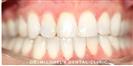 Dental Braces - Dr. Michael’s Dental Clinics