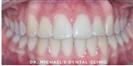 Dental Braces - Dr. Michael’s Dental Clinics