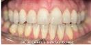 Dental Braces - Dr. Michael’s Dental Clinics