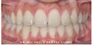 Dental Braces - Dr. Michael’s Dental Clinics