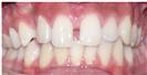 Dental Braces - Dr. Michael’s Dental Clinics