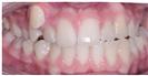 Dental Braces - Dr. Michael’s Dental Clinics
