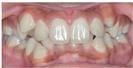 Dental Braces - Dr. Michael’s Dental Clinics