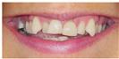 Braces and Veneers - Dr. Michael’s Dental Clinics
