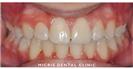 Dental Braces - Micris Dental Clinics