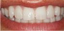 Dental Veneers - Micris Dental Clinics