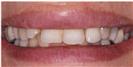 Dental Veneers - Micris Dental Clinics