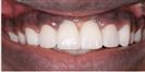 Zirconia Bridge - Micris Dental Clinics