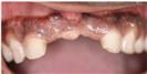 Zirconia Bridge - Micris Dental Clinics