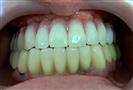 Bridge from 10 porcelain/ceramic crowns for the upper jaw - Implant Eladent