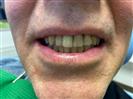 Fast & Fixed Sky System Bredent with 2 implants and 4 teeth for the lower jaw - Implant Eladent