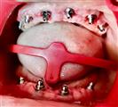 Fast & Fixed Sky System Bredent for the whole mouth - Implant Eladent