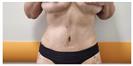 Abdominoplasty - Can Healthcare Group