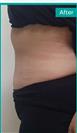 Abdominoplasty - Can Healthcare Group
