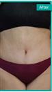 Abdominoplasty - Can Healthcare Group
