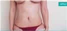 Abdominoplasty - Can Healthcare Group