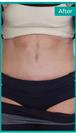 Abdominoplasty - Can Healthcare Group