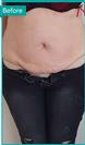 Abdominoplasty - Can Healthcare Group