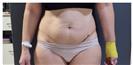 Abdominoplasty - Can Healthcare Group