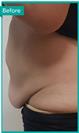 Abdominoplasty - Can Healthcare Group