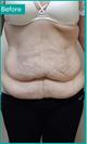 Abdominoplasty - Can Healthcare Group