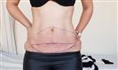 Abdominoplasty - Can Healthcare Group