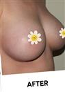 Breast Enlargement - Can Healthcare Group