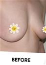 Breast Enlargement - Can Healthcare Group