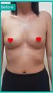 Breast Enlargement - Can Healthcare Group