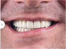 Dental Implants - Can Healthcare Group