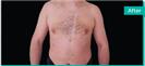 Gynecomastia - Can Healthcare Group