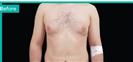 Gynecomastia - Can Healthcare Group