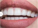 Laser Teeth Whitening - Can Healthcare Group