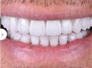 Laser Teeth Whitening - Can Healthcare Group