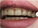 Laser Teeth Whitening - Can Healthcare Group