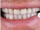 Laser Teeth Whitening - Can Healthcare Group