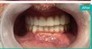Porcelain Veneers - Can Healthcare Group
