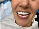 Porcelain Veneers - Can Healthcare Group
