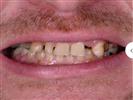 Porcelain Veneers - Can Healthcare Group