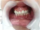 Porcelain Veneers - Can Healthcare Group