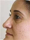 Rhinoplasty - Can Healthcare Group