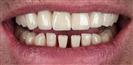 Dental Implants - West Dental Clinic